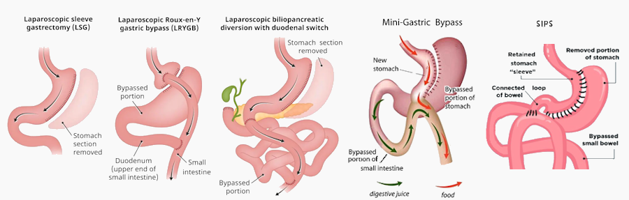 BariatricTypes