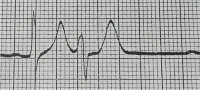 ECG